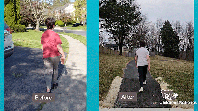 2 pictures of teen boy walking - the first with an abnormal gait, the second with a normal gait